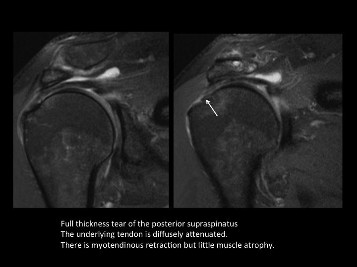Figure 3 for case tendon of rotator cuff ( RID1948 )